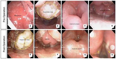 Case report: Suspicious laryngeal mass: a case of laryngeal lymphoma misdiagnosed as chronic inflammation